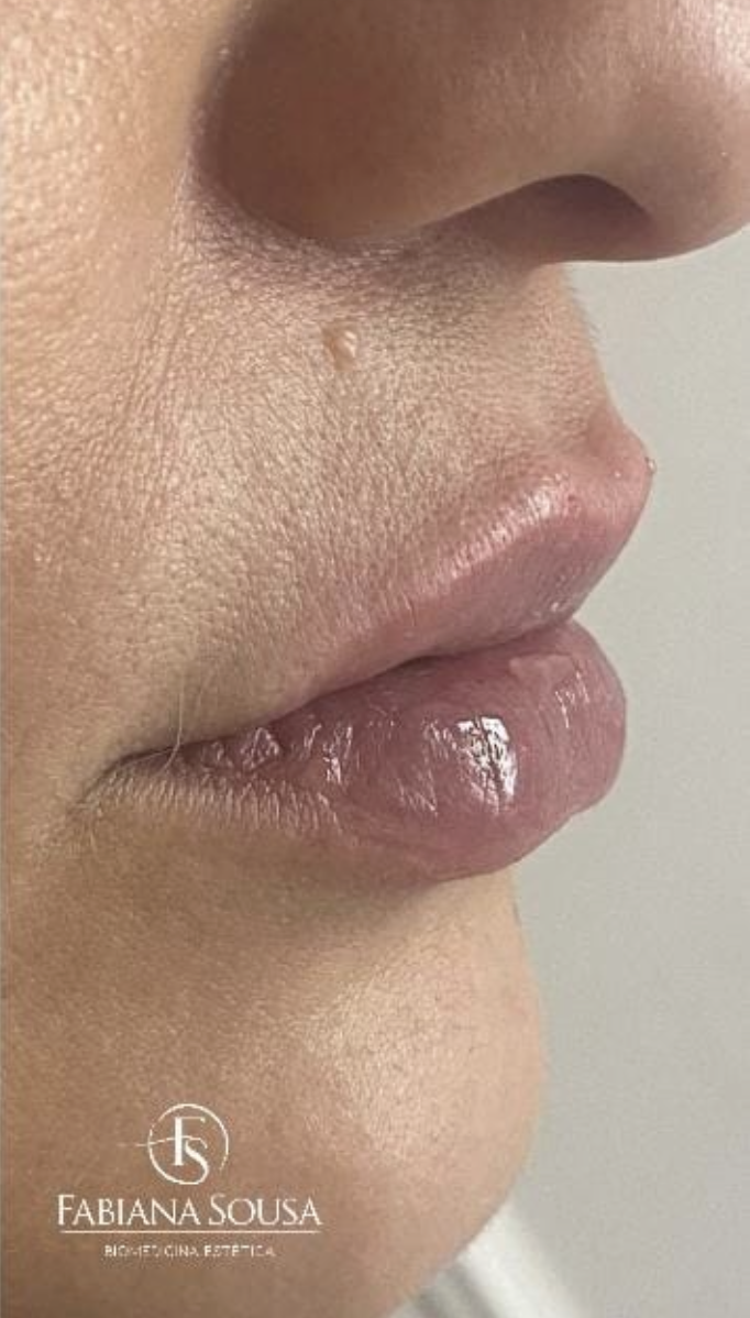 Depois - Preenchimento Labial